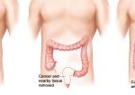 Preventing Colon Cancer