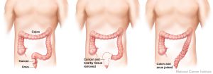 Preventing Colon Cancer